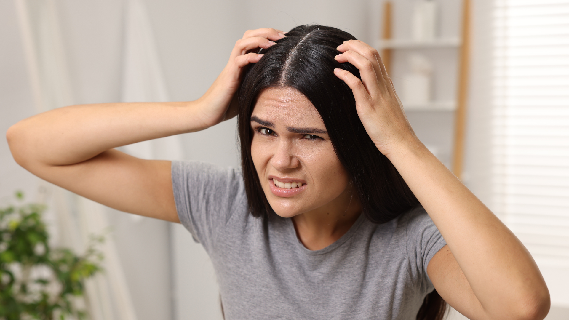 Natural Remedies for Dandruff
